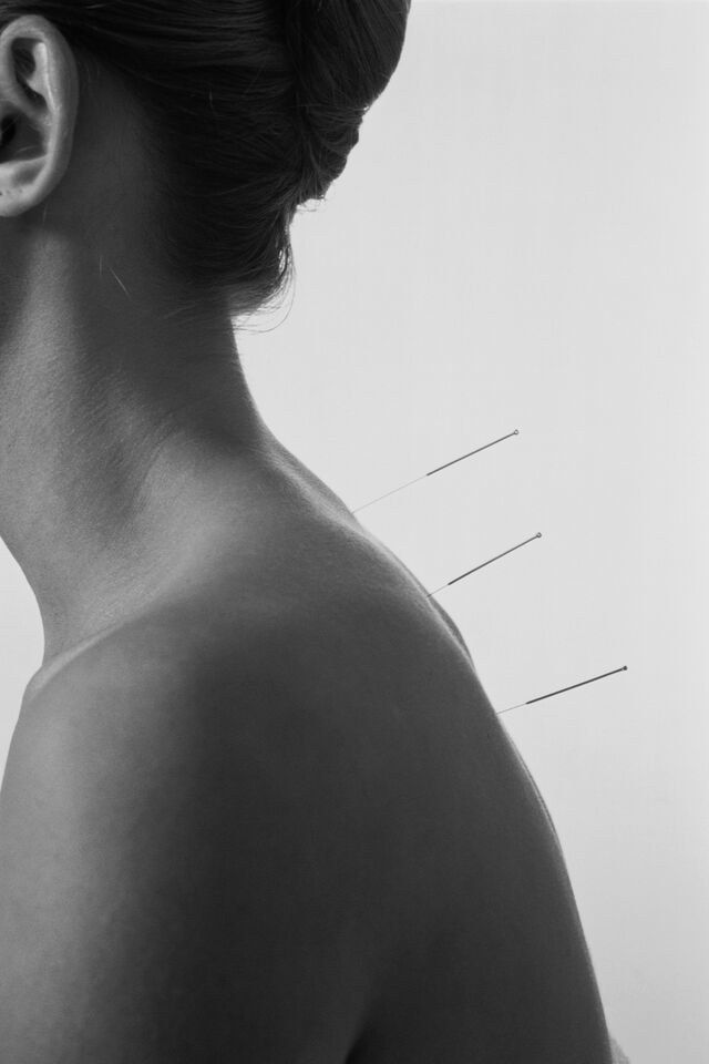 Acupuncture en Médecine Traditionnelle Chinoise sur le dos